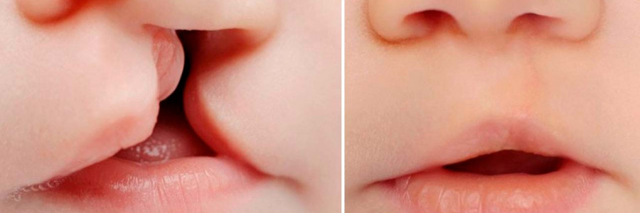 El reto de promover la salud integral en niños con labio y paladar hendido