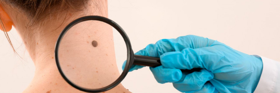 Melanoma: el tipo de cáncer de piel más peligroso